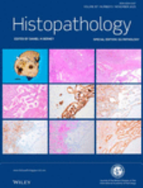 皮肤原发肉瘤样鳞状细胞癌