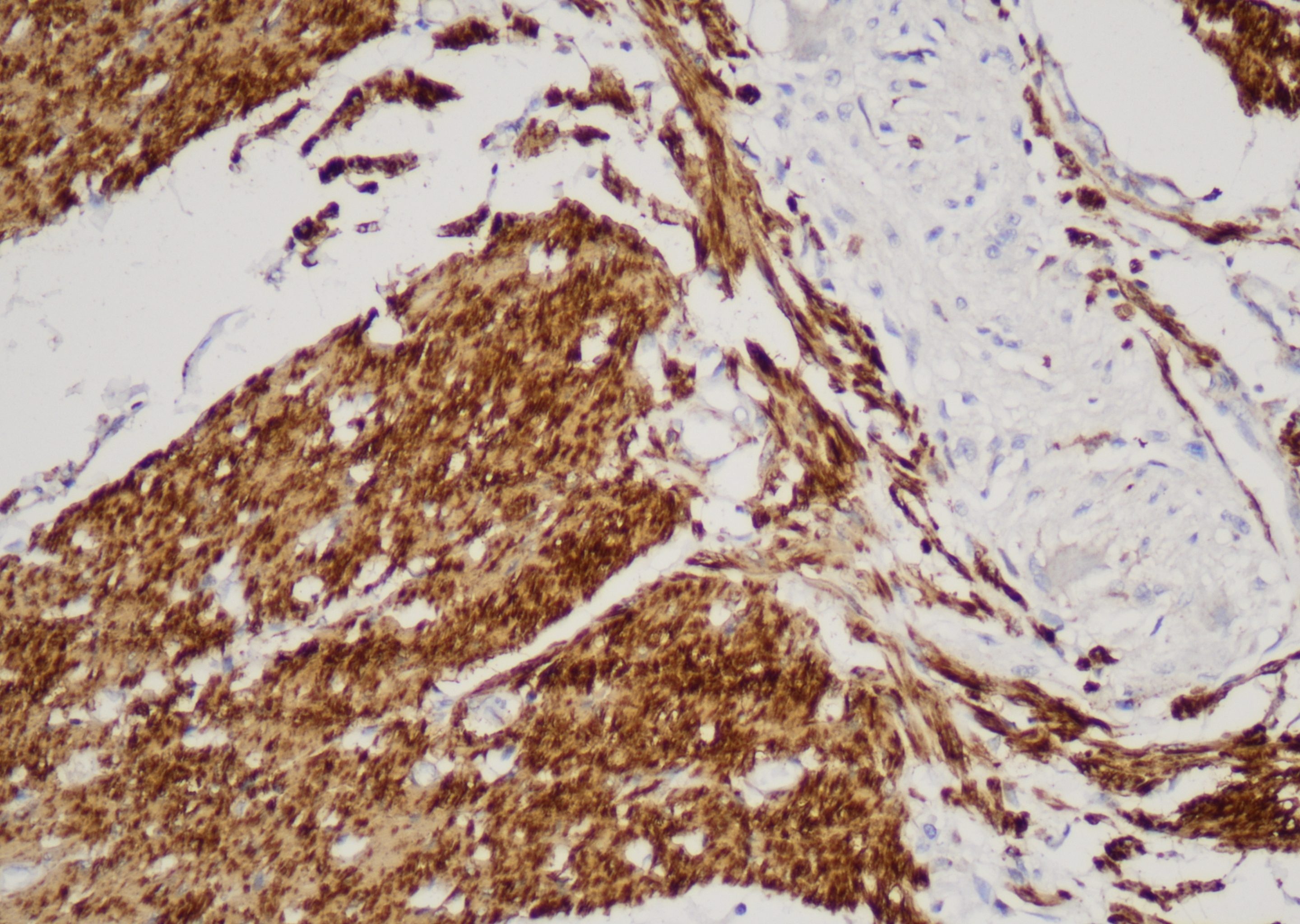 多癌种染色升级！免疫组化“老大难”这样解